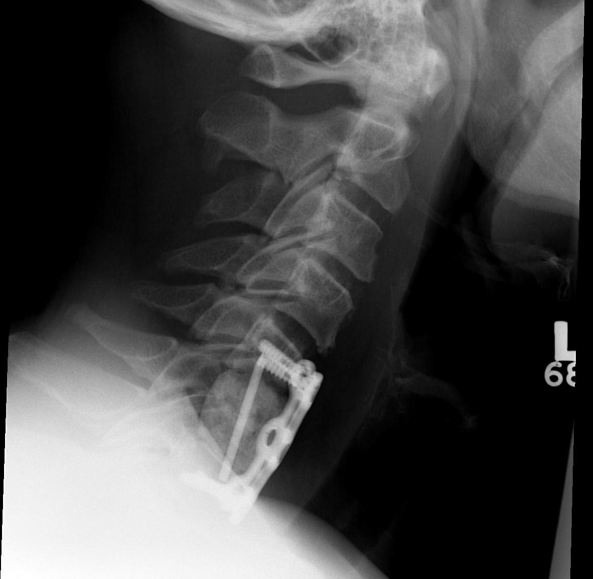 Cervical Spine Metastasis Anterior Stabilisation